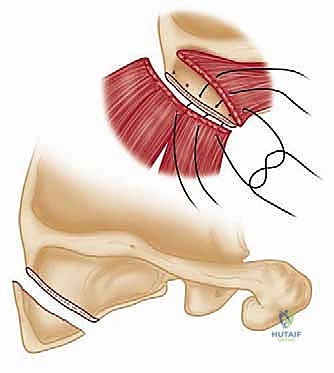 صورة توضيحية لـ متلازمة الكتف الطرقعي: دليل شامل للعلاج والتعافي مع الأستاذ الدكتور محمد هطيف