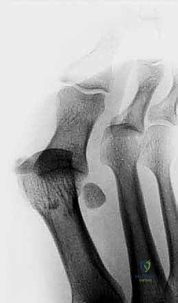 تصنيف درجات الإصابة والتمزق