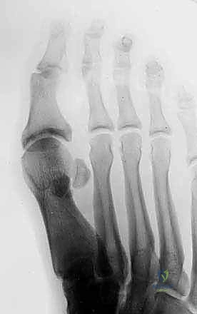 الأعراض السريرية لإصابة Turf Toe