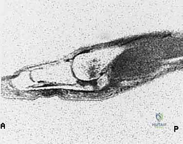 إصابة إصبع القدم العشبي (Turf Toe): دليل شامل للتشخيص والعلاج الجراحي مع الأستاذ الدكتور محمد هطيف