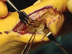 استكشاف وتقييم الأنسجة الممزقة