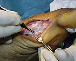 الشق الجراحي والوصول للمفصل