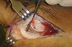 إصلاح الصفيحة الأخمصية باستخدام الخطافات