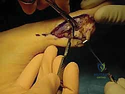 صورة طبية: إصابة إصبع القدم العشبي (Turf Toe): دليل شامل للتشخيص والعلاج الجراحي مع الأستاذ الدكتور محمد هطيف