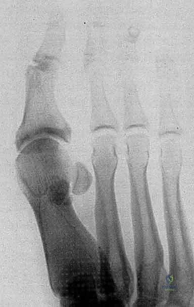 صورة توضيحية لـ إصابة إصبع القدم العشبي (Turf Toe): دليل شامل للتشخيص والعلاج الجراحي مع الأستاذ الدكتور محمد هطيف