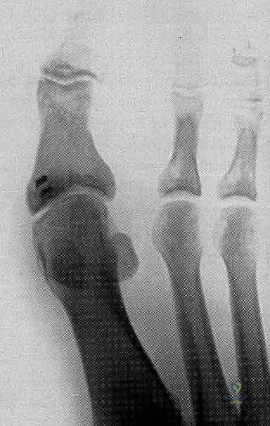 صورة توضيحية لـ إصابة إصبع القدم العشبي (Turf Toe): دليل شامل للتشخيص والعلاج الجراحي مع الأستاذ الدكتور محمد هطيف