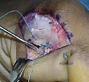 صورة طبية: إصابة إصبع القدم العشبي (Turf Toe): دليل شامل للتشخيص والعلاج الجراحي مع الأستاذ الدكتور محمد هطيف