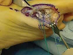 صورة طبية: إصابة إصبع القدم العشبي (Turf Toe): دليل شامل للتشخيص والعلاج الجراحي مع الأستاذ الدكتور محمد هطيف