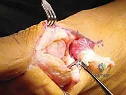 إغلاق الجرح وتثبيت المفصل