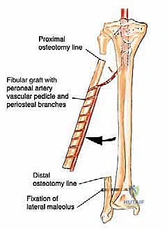 تشريح الأوعية الدموية المغذية لعظمة الشظية