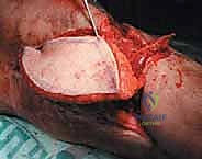 تثبيت العظم المنقول باستخدام الشرائح والمسامير الحديثة