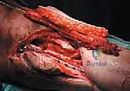 التوصيل المجهري للأوعية الدموية تحت الميكروسكوب