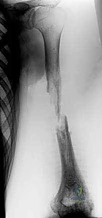 تجهيز الشريان المستقبل في الطرف المصاب