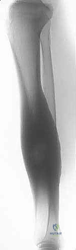 الأوعية الدموية الدقيقة أثناء عملية ترقيع الشظية الوعائي