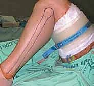 تطور الالتئام العظمي بعد شهرين من الجراحة