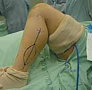 صورة طبية تظهر دقة التثبيت الداخلي للعظم المزروع