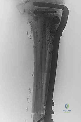 صورة توضيحية لـ ترقيع الشظية الوعائي الحر: إتقان إعادة بناء العظام الطويلة المعقدة في صنعاء مع الأستاذ الدكتور محمد هطيف