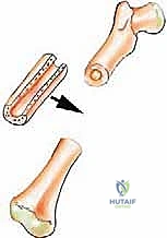صورة توضيحية لـ ترقيع الشظية الوعائي الحر: إتقان إعادة بناء العظام الطويلة المعقدة في صنعاء مع الأستاذ الدكتور محمد هطيف