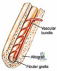 صورة توضيحية لـ ترقيع الشظية الوعائي الحر: إتقان إعادة بناء العظام الطويلة المعقدة في صنعاء مع الأستاذ الدكتور محمد هطيف