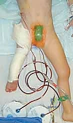 التخطيط لإعادة بناء مفصل الورك قبل التطويل