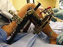 صورة لعملية تدوير الساق (Rotationplasty) في الحالات الشديدة