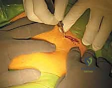 Illustration of adductorrelated groin pain - Dr. Mohammed Hutaif