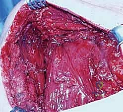 عملية إيدن لانج: حل جراحي متقدم لشلل العضلة شبه المنحرفة وتثبيت الكتف