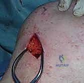 صورة توضيحية لـ عملية إيدن لانج: حل جراحي متقدم لشلل العضلة شبه المنحرفة وتثبيت الكتف