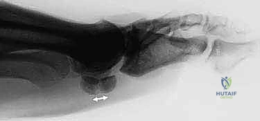 الأشعة السينية لتشخيص كسور القدم