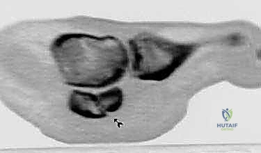 التصوير بالرنين المغناطيسي للعظم السمسمي