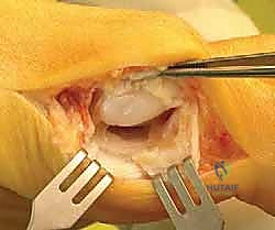 الأستاذ الدكتور محمد هطيف أفضل طبيب عظام في صنعاء