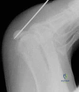 صورة توضيحية لـ كسور العظم السمسمي لإبهام القدم: دليل شامل للتثبيت الداخلي الدقيق مع الأستاذ الدكتور محمد هطيف