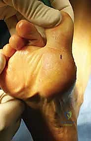 صورة توضيحية لـ كسور العظم السمسمي لإبهام القدم: دليل شامل للتثبيت الداخلي الدقيق مع الأستاذ الدكتور محمد هطيف