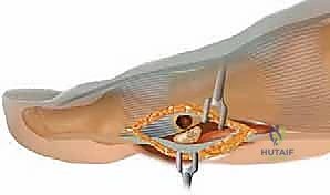 كسور العظم السمسمي لإبهام القدم: دليل شامل للتثبيت الداخلي الدقيق مع الأستاذ الدكتور محمد هطيف