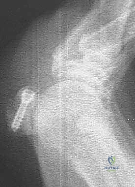 صورة طبية: كسور العظم السمسمي لإبهام القدم: دليل شامل للتثبيت الداخلي الدقيق مع الأستاذ الدكتور محمد هطيف
