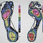 صورة توضيحية لـ كسور العظم السمسمي لإبهام القدم: دليل شامل للتثبيت الداخلي الدقيق مع الأستاذ الدكتور محمد هطيف