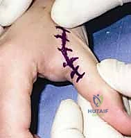 Illustration of reconstruction of chronic - Dr. Mohammed Hutaif