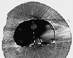 صورة توضيحية لـ جراحة مراجعة مفصل الركبة المتصلب علاج شامل لاستعادة الحركة في صنعاء مع الأستاذ الدكتور محمد هطيف