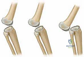 Illustration of dislocation of the knee - Dr. Mohammed Hutaif