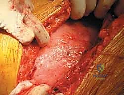 صورة من داخل غرفة العمليات توضح الدقة المتناهية في استئصال الأورام