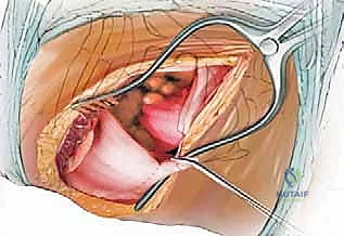 صورة توضيحية لـ المدخل الأمامي للعمود الفقري الصدري: دليل شامل للمرضى مع الأستاذ الدكتور محمد هطيف في صنعاء