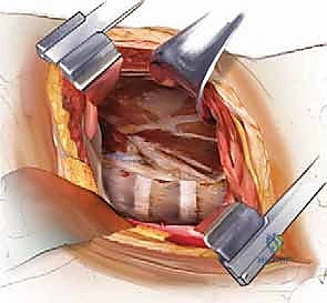 استخدام أحدث تقنيات التثبيت وإعادة البناء للعمود الفقري