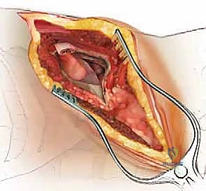 أشعة رنين مغناطيسي توضح انزلاقاً غضروفياً صدرياً ضاغطاً على الحبل الشوكي