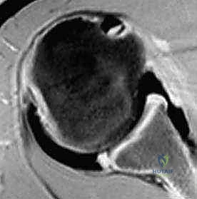 صورة توضيحية لـ إصلاح عدم استقرار الكتف الخلفي بالمنظار: دليل شامل للمرضى مع الأستاذ الدكتور محمد هطيف بصنعاء