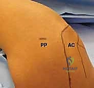 صورة توضيحية لـ إصلاح عدم استقرار الكتف الخلفي بالمنظار: دليل شامل للمرضى مع الأستاذ الدكتور محمد هطيف بصنعاء