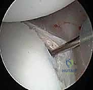 صورة توضيحية لـ إصلاح عدم استقرار الكتف الخلفي بالمنظار: دليل شامل للمرضى مع الأستاذ الدكتور محمد هطيف بصنعاء