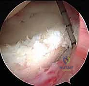 صورة توضيحية لـ إصلاح عدم استقرار الكتف الخلفي بالمنظار: دليل شامل للمرضى مع الأستاذ الدكتور محمد هطيف بصنعاء