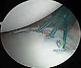 إصلاح عدم استقرار الكتف الخلفي بالمنظار: دليل شامل للمرضى مع الأستاذ الدكتور محمد هطيف بصنعاء