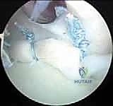 صورة توضيحية لـ إصلاح عدم استقرار الكتف الخلفي بالمنظار: دليل شامل للمرضى مع الأستاذ الدكتور محمد هطيف بصنعاء