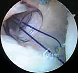 صورة توضيحية لـ إصلاح عدم استقرار الكتف الخلفي بالمنظار: دليل شامل للمرضى مع الأستاذ الدكتور محمد هطيف بصنعاء